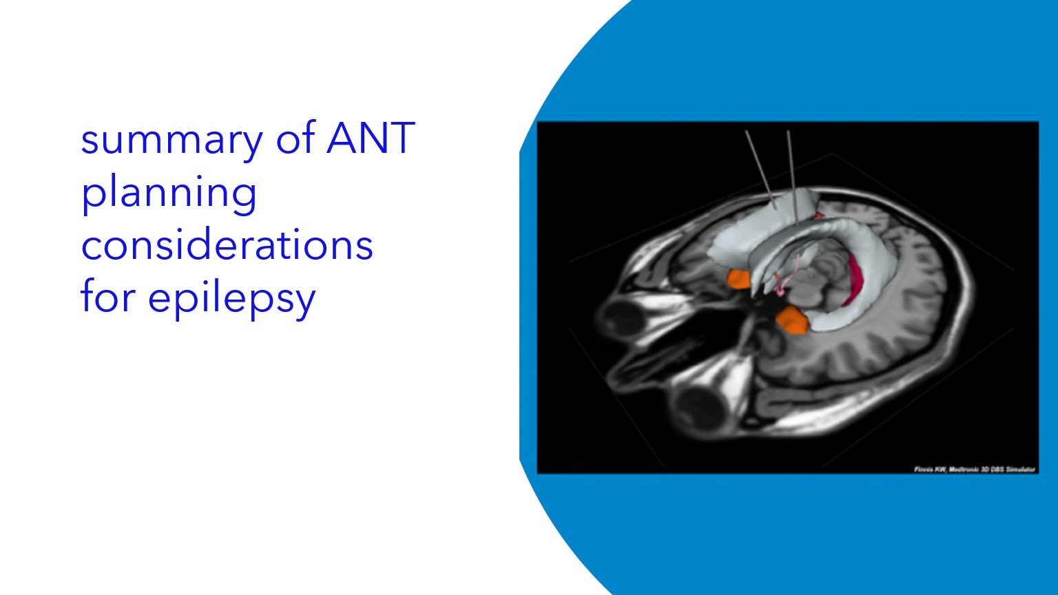 Summary of ANT planning considerations for epilepsy|Resumen de las consideraciones de planificación de ANT para la epilepsia|Resumo das considerações de planejamento da ANT para epilepsia