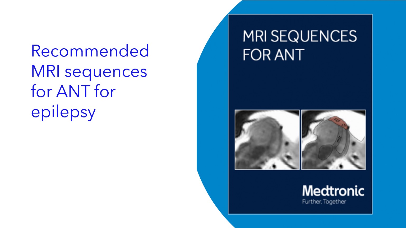 Recommended MRI sequences for ANT for epilepsy|Secuencias de resonancia magnética recomendadas para ANT para epilepsia|Sequências de ressonância magnética recomendadas para a ANT para epilepsia