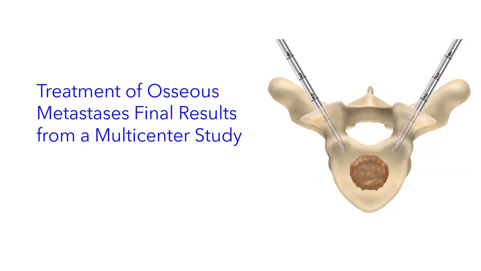 Treatment of Osseous Metastases Final Results from a Multicenter Study